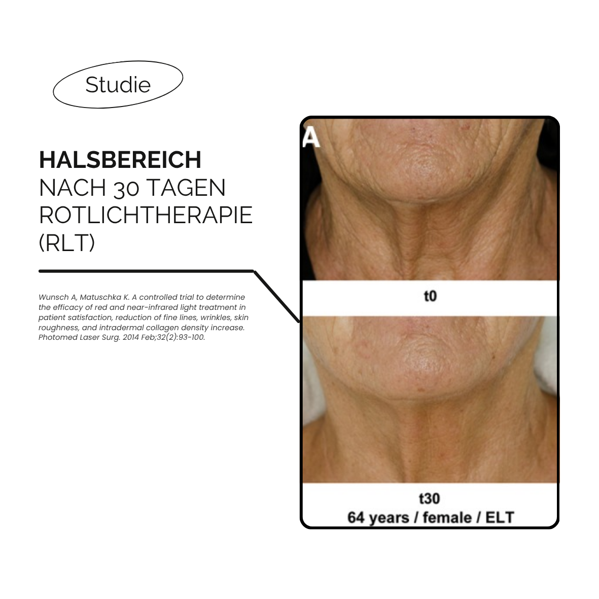 LED-Rotlicht-Gesichtsmaske-Maske-Hals-Dekollete-Bewertung-Review-kaufen-schweiz-therapie-studie