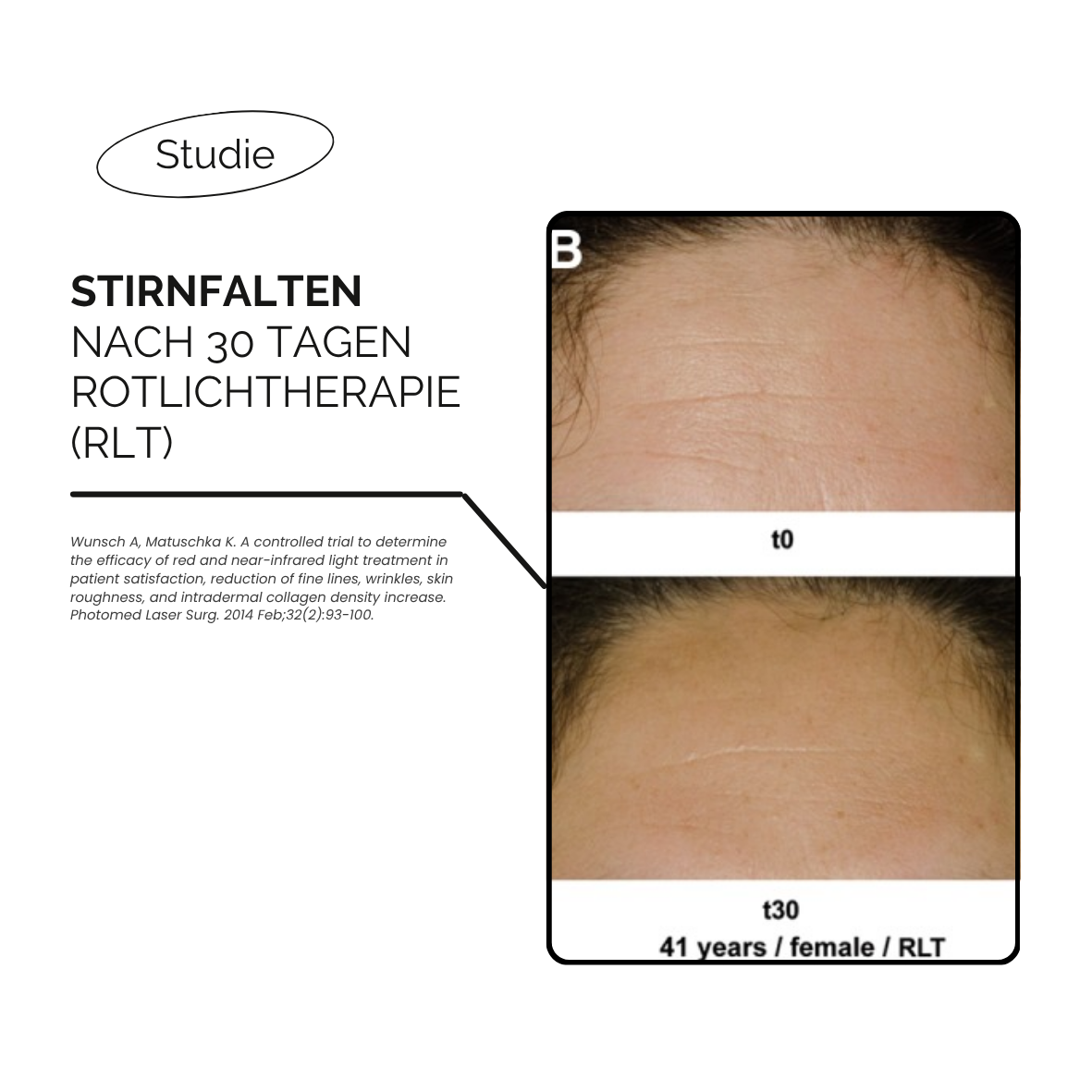 LED-Rotlicht-Gesichtsmaske-Maske-Hals-Dekollete-Bewertung-Review-kaufen-schweiz-therapie-studie